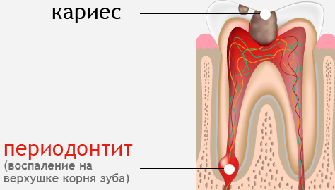 Лечение на периодонтит